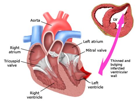 Left ventricular aneurysm and pseudoaneurysm following acute.